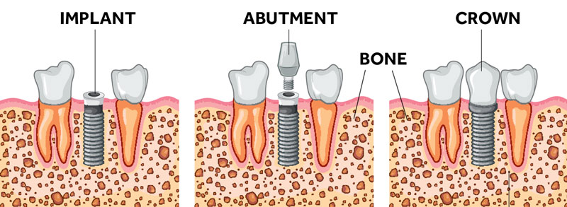 Dental Implant Diagram