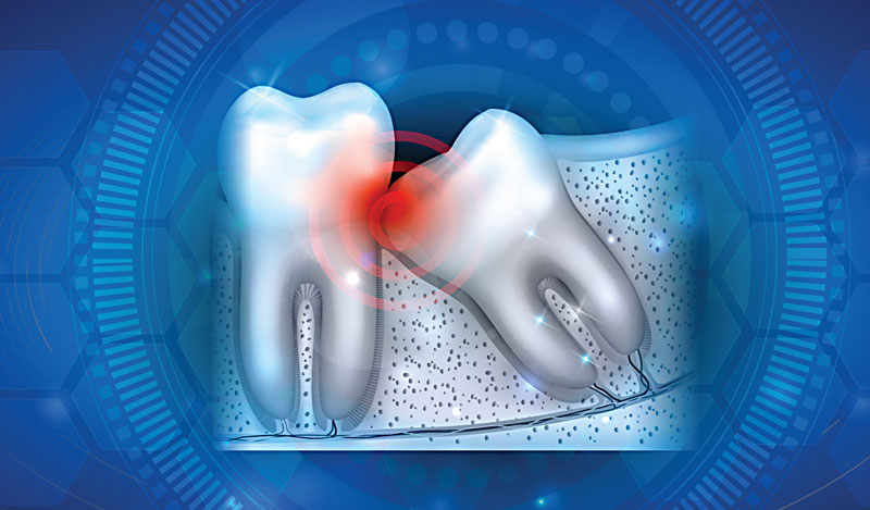 Wisdom Teeth Extraction Botanic Ridge